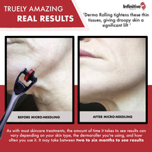 Load image into Gallery viewer, MT Titanium Derma Roller 180 Needle