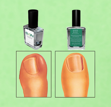 Load image into Gallery viewer, Skinapeel Toenail Softener & Ingrowing Toenail Prevention Oil – Free UK Delivery