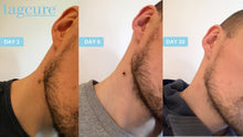 Load image into Gallery viewer, Tagcure Skin Tag Removal Device For Skin Tags 0.5cm or Less - Optional Refill Pack - Unisex