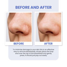 Load image into Gallery viewer, Blackhead &amp; Spot Removal Tool Kits – Professional-Grade Skincare Solutions