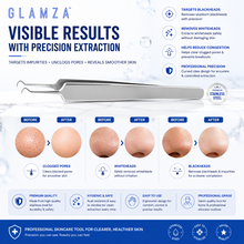 Load image into Gallery viewer, Glamza Curved Blackhead Removal Claw Tweezer – Professional Precision for Clearer Skin - FREE POSTAGE