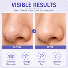 Load image into Gallery viewer, Electric Blackhead Remover &amp; Pore Cleanser