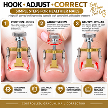 Load image into Gallery viewer, Ingrown Toenail Corrector Clamp – Professional Relief &amp; Nail Reshaping Tool