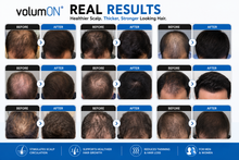 Load image into Gallery viewer, Volumon Laser Hair Massage Comb – Stimulate Hair Growth &amp; Boost Scalp Health - FREE Postage Across the UK!