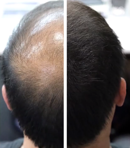 Volumon Hair Loss Building Fibres - COTTON 12g - For Men & Women!