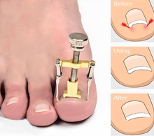 Load image into Gallery viewer, Ingrown Toenail Corrector Clamp – Professional Relief &amp; Nail Reshaping Tool