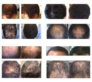 Volumon Hair Regrowth Solution Spray 60ml