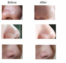 Load image into Gallery viewer, Pore Cleansing Blackhead, Pimple, Zit &amp; Acne Remover